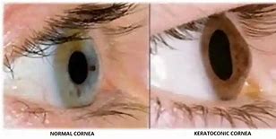 Bệnh Keratoconus Là Gì